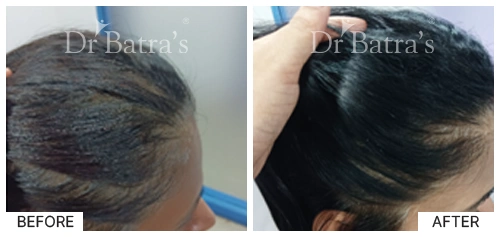 Hair Falling Treatment